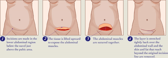 Operating-time-of-the-mini-tummy-tuck